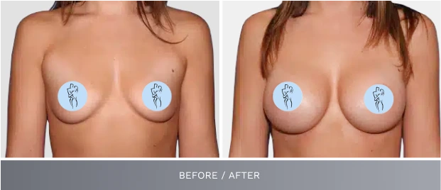 Before and after breast augmentation results, front view