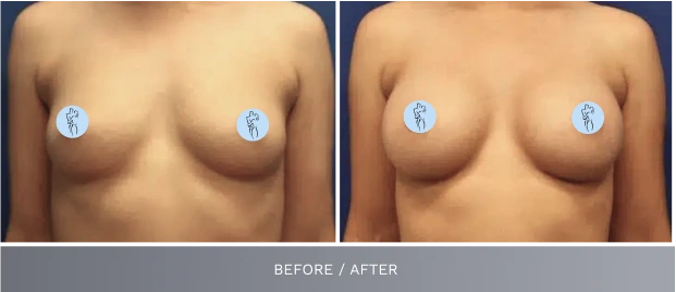Before and after breast augmentation results showing improved shape and symmetry