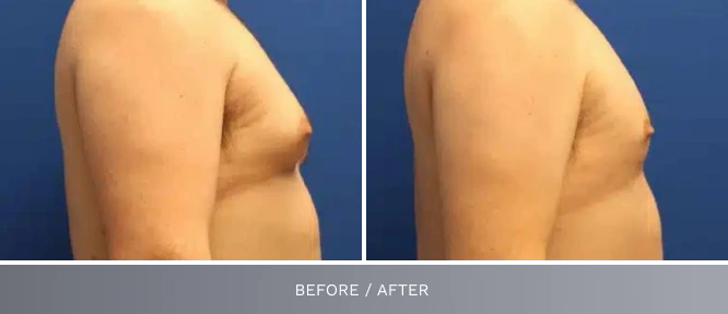 Before and after male chest side profile view labeled before/after, showing torso changes