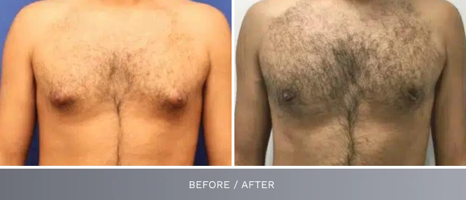 Before and after male chest front view labeled before/after, comparing initial and treated appearance