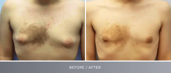 Before and after male chest front view labeled before/after, showing torso transformation