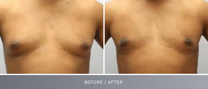Before and after male chest front view labeled before/after against white background
