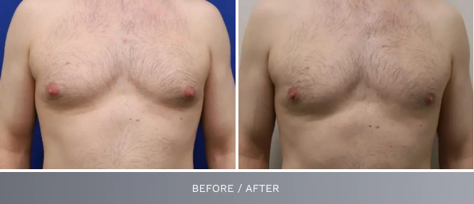 Before and after male chest front view labeled before/after, comparing blue and gray background results