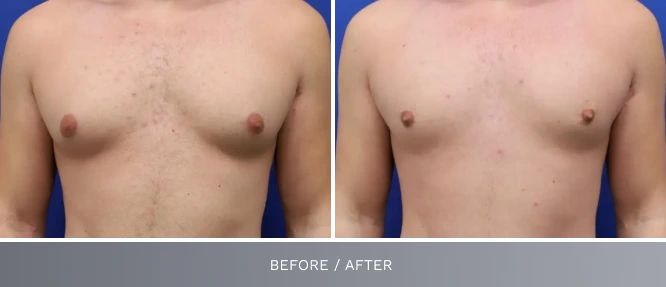 Before and after comparison of male chest showing glandular tissue reduction