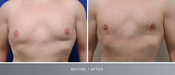 Before and after comparison of male chest showing glandular tissue reduction