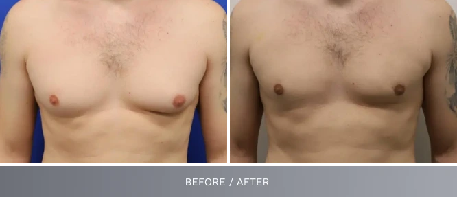 Before and after comparison of male chest showing glandular tissue reduction