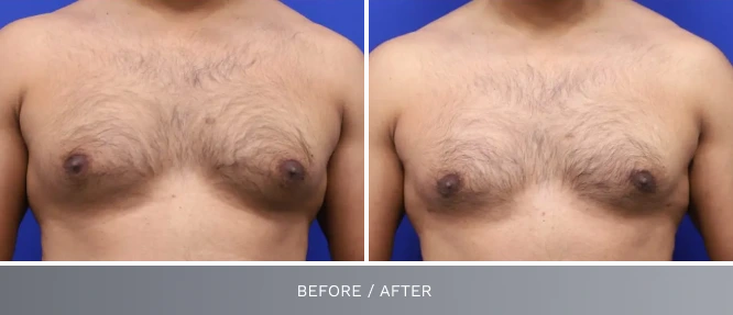 Before and after comparison of male chest showing glandular tissue reduction