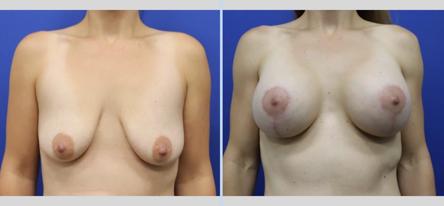 Before and After Gallery: Breast Lift A Banner