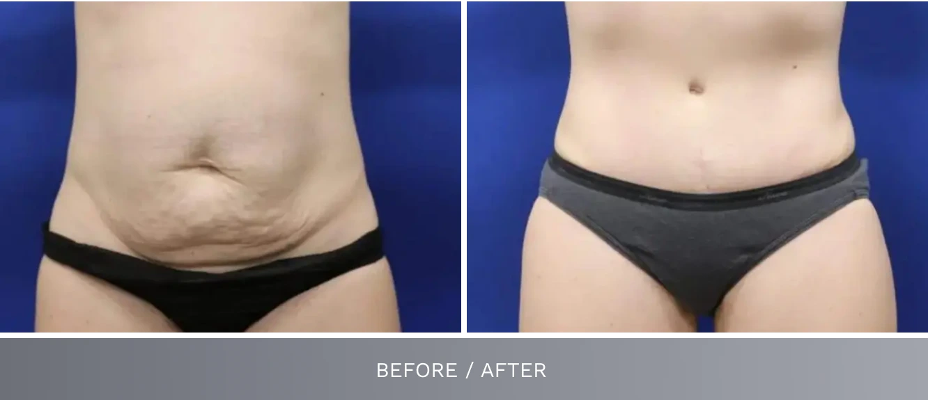 Tummy tuck before and after comparison: left shows abdominal fullness and loose skin, right shows flattened contoured midsection