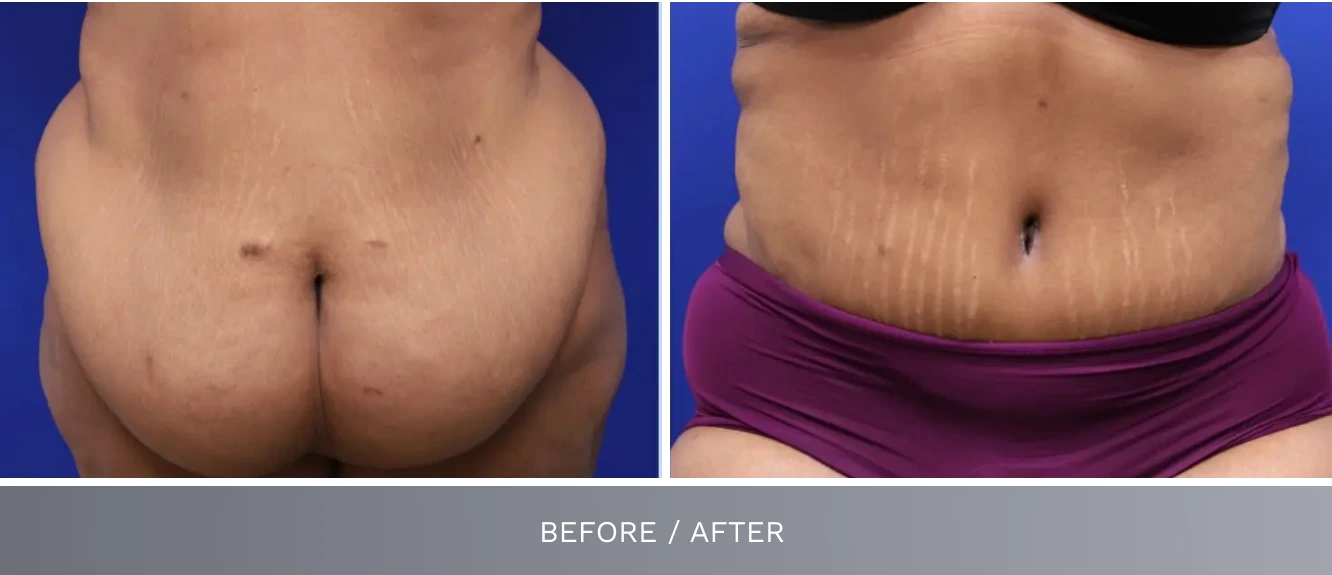 Tummy tuck before and after showing reduced abdominal skin laxity and flatter contour