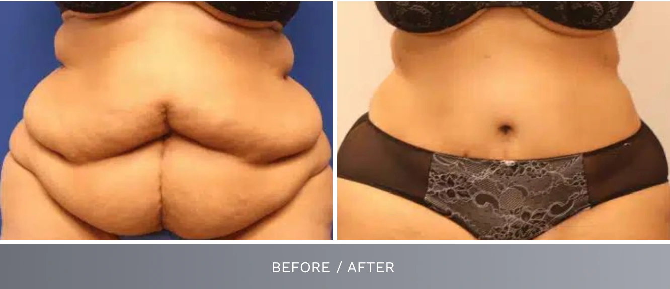 Tummy tuck before and after demonstrating improved abdominal definition and contour