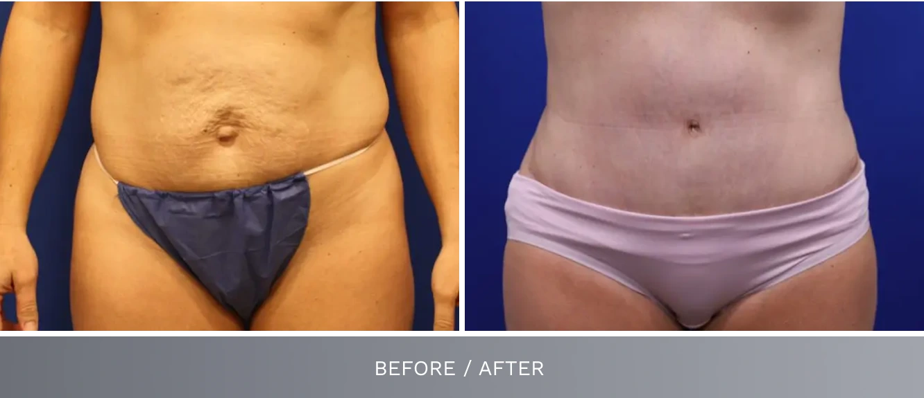 Tummy tuck before and after showing tightened abdomen and reduced excess skin