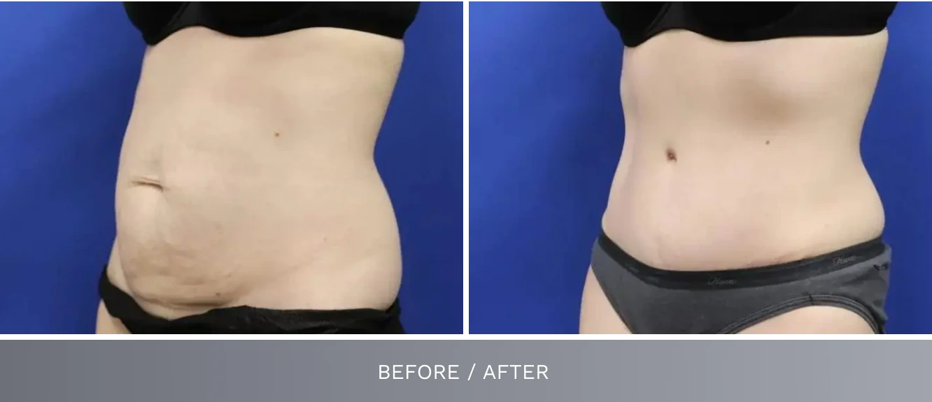 Tummy tuck before and after displaying smoother abdominal profile and improved contour