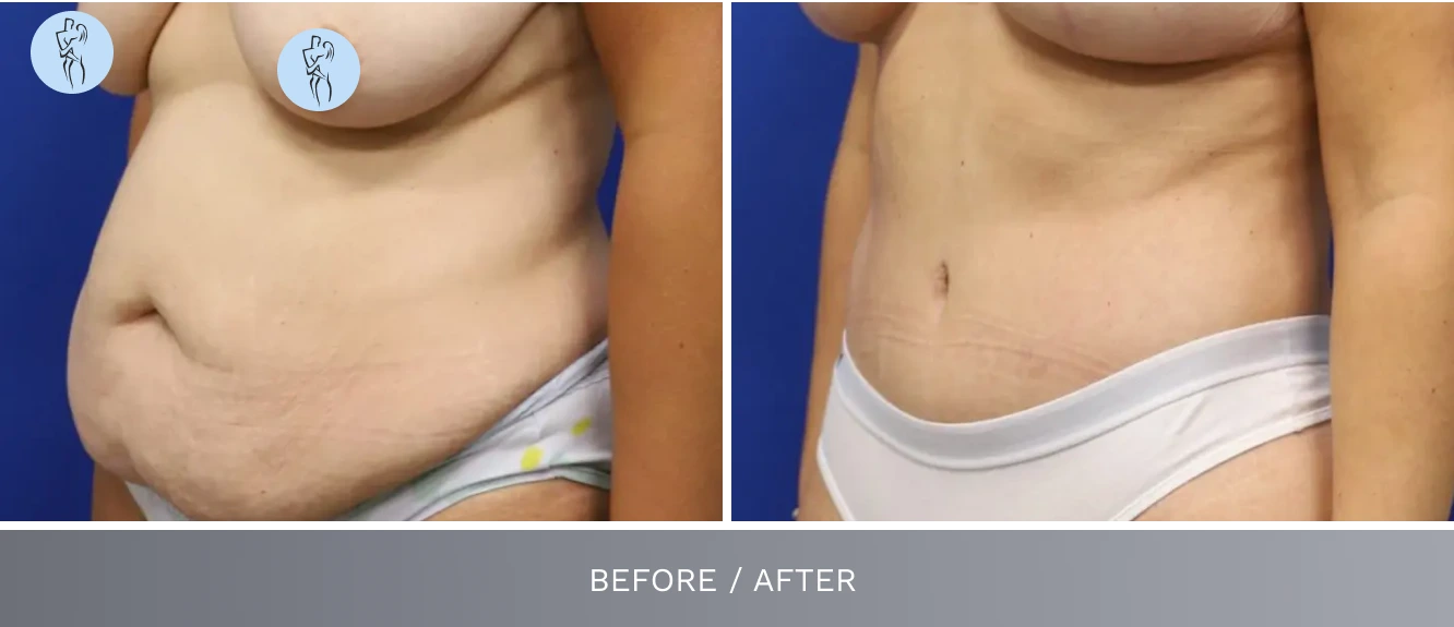 Tummy tuck before and after revealing flatter, more defined abdominal appearance