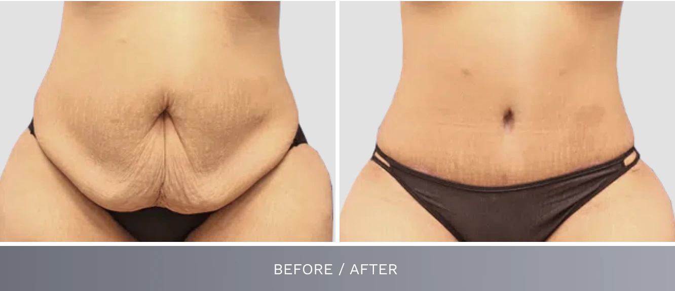 Tummy tuck before and after: loose abdominal skin before surgery, flat abdomen after