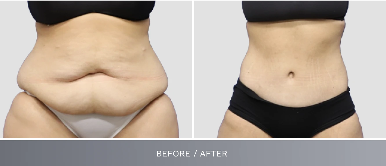 Tummy tuck before and after: protruding belly before surgery, toned midsection after