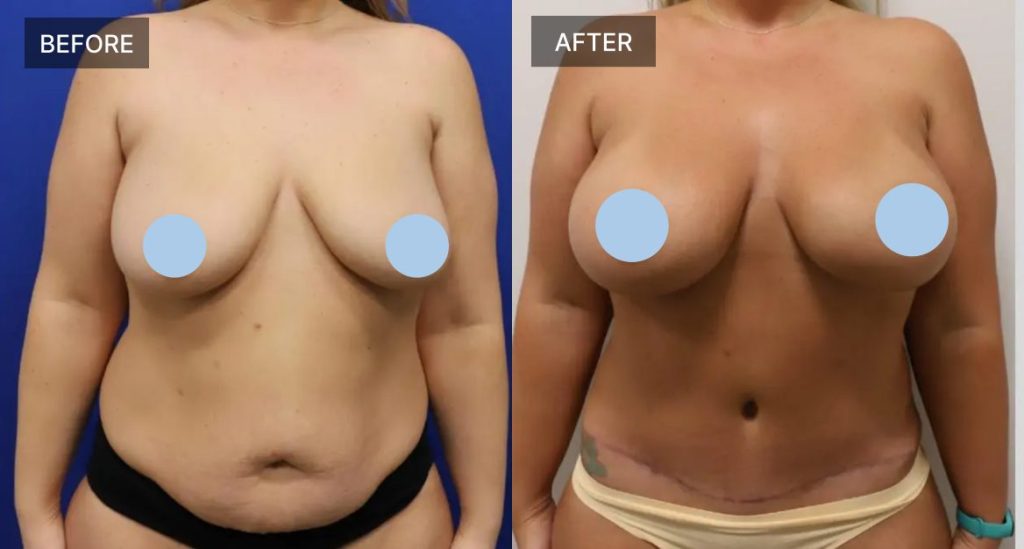 mommy makeover results Banner