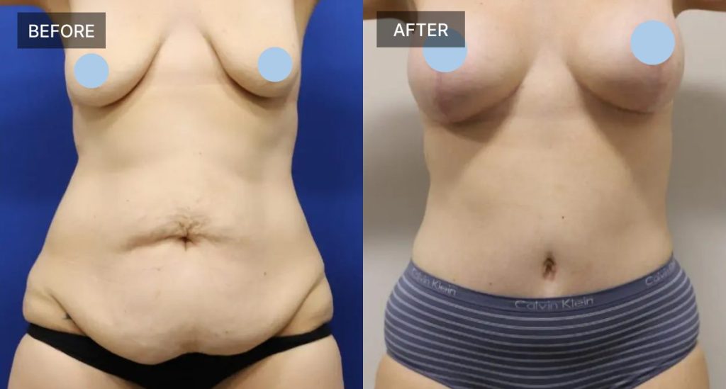 mommy makeover results Banner