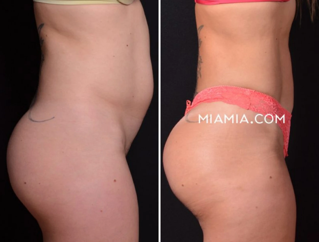 Before and after comparison of buttock augmentation, side view