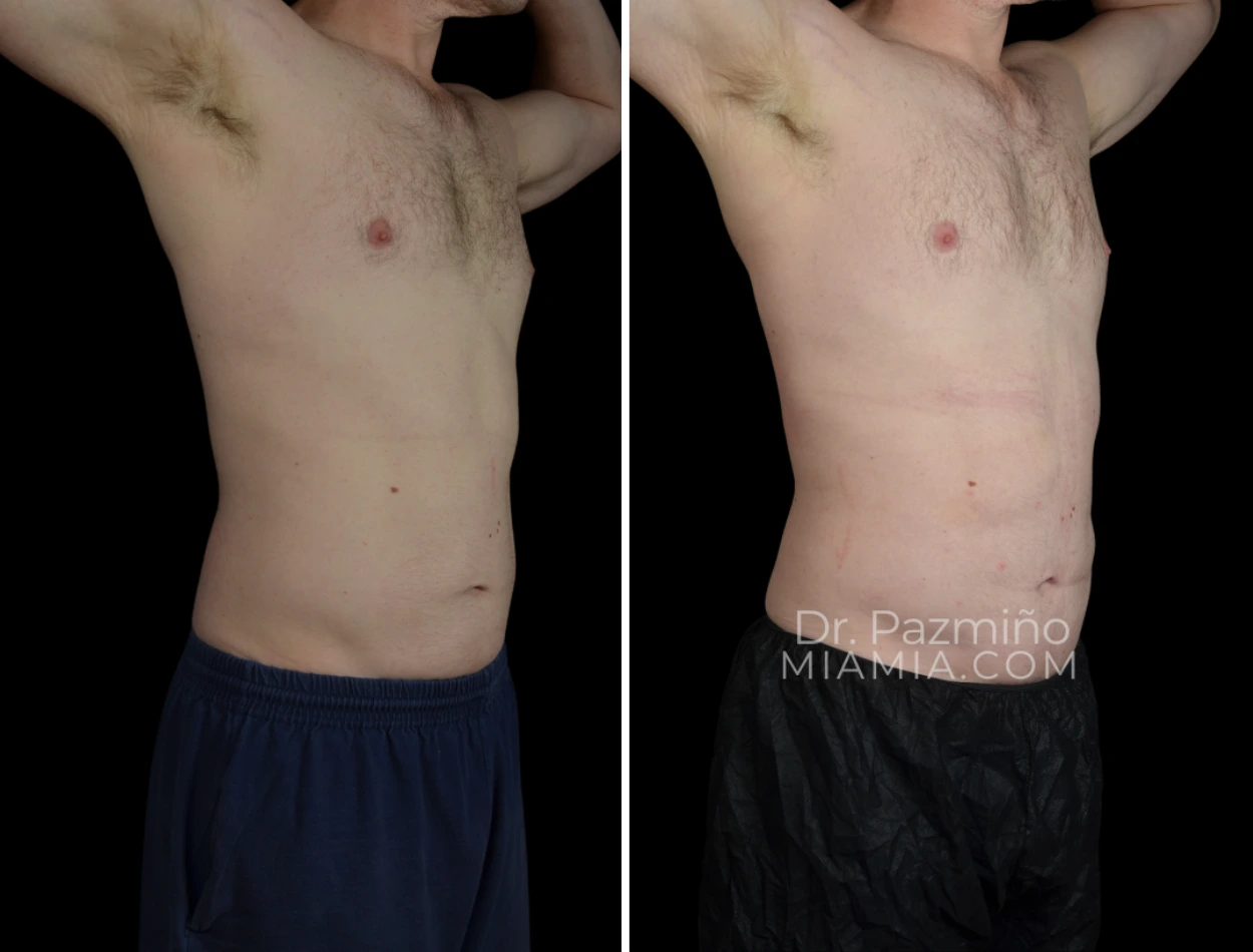 Before and after male torso showing reduced abdominal and flank fat from liposuction
