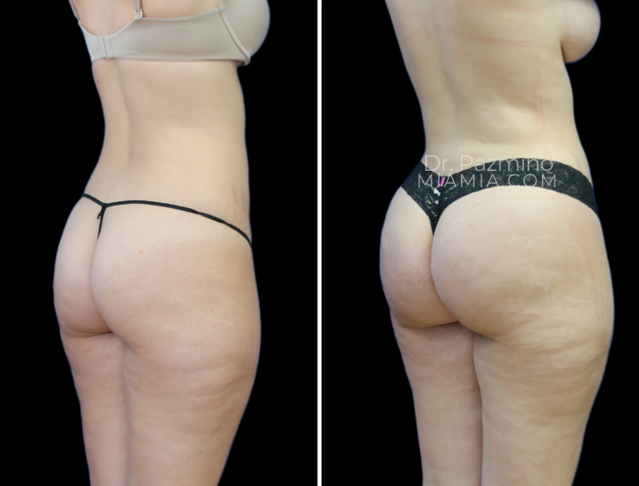 Before and after buttock enhancement rear view showing increased volume and shape