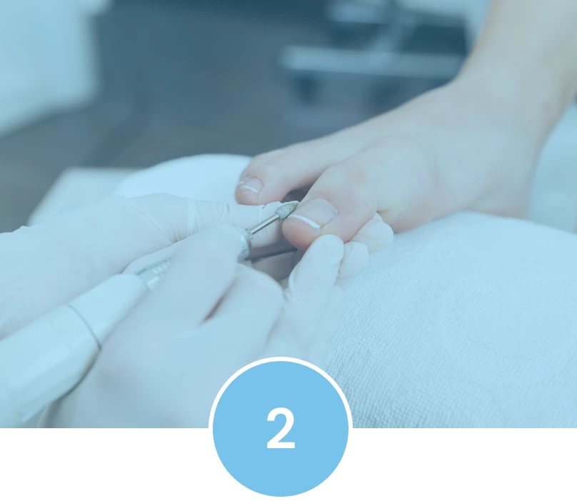 Laser Treatment Procedure for Nail Fungus: Preparation Banner