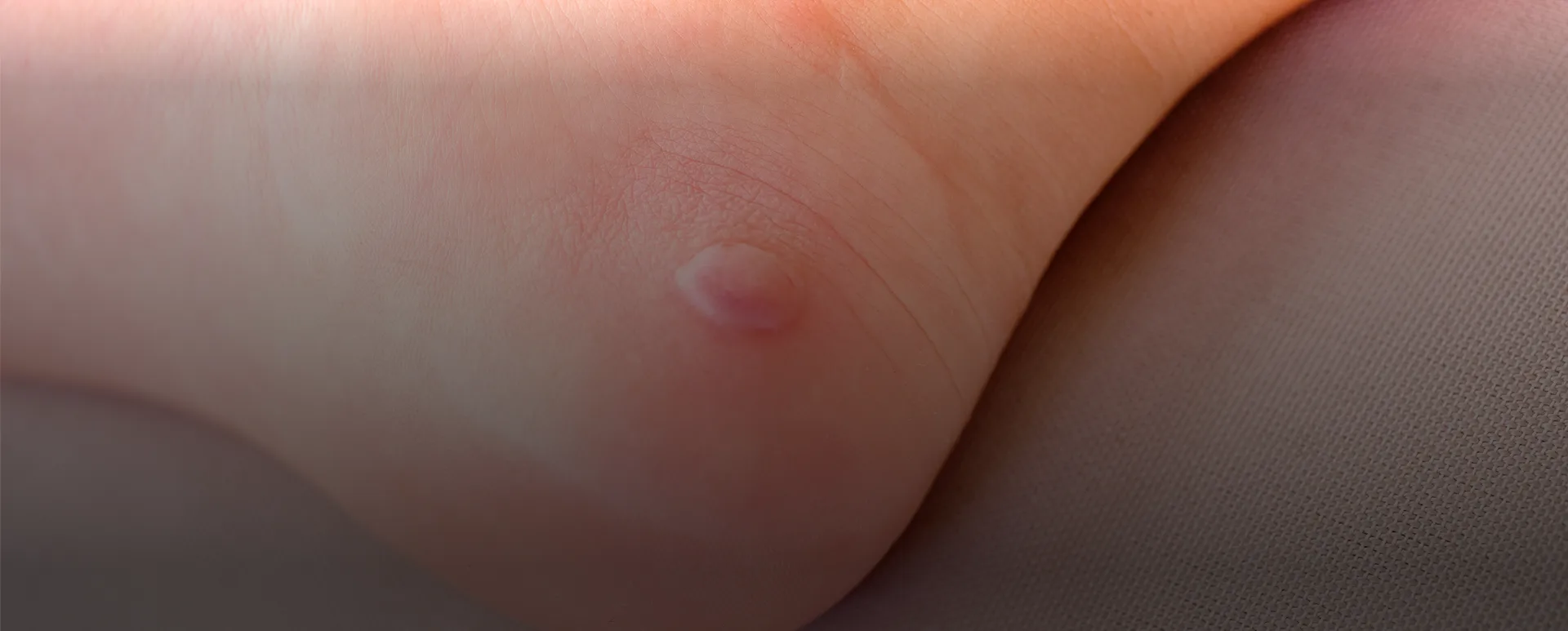 Blister Treatment in Novi, Southfield, Howell, Livonia BG