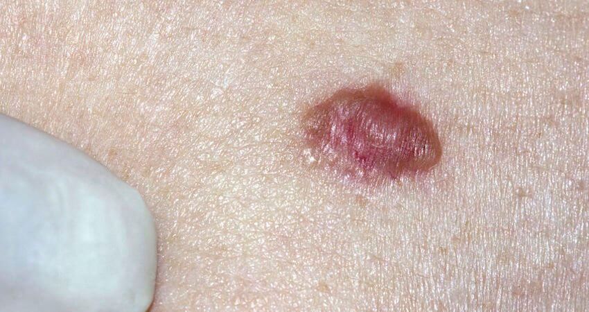 Dark reddish-brown lesion on skin, example of foot melanoma