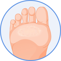 Calluses Treatment in Novi, Southfield, Howell, and Livonia, MI Banner