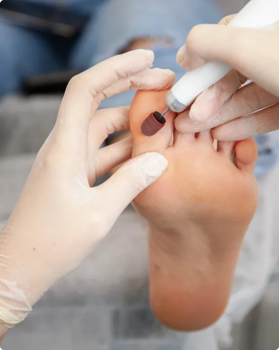Corn and Callus Removal in Novi, Southfield, Howell & Livonia, MI Banner