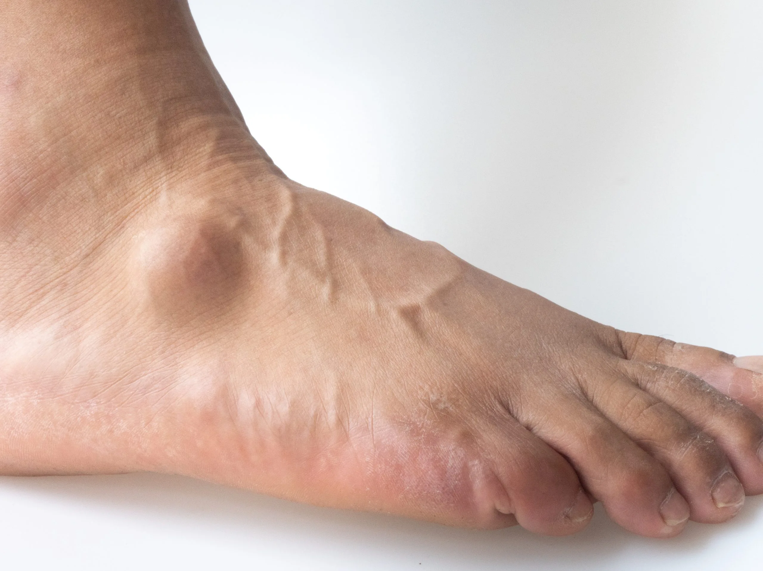 Swollen foot showing inflammation and redness on inner ankle and arch area
