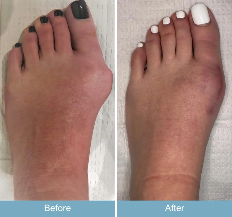 Before and after photos of foot with reduced swelling