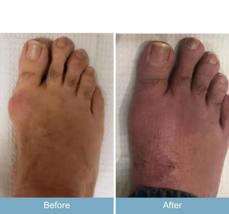 Before and after foot showing reduced swelling and improved color