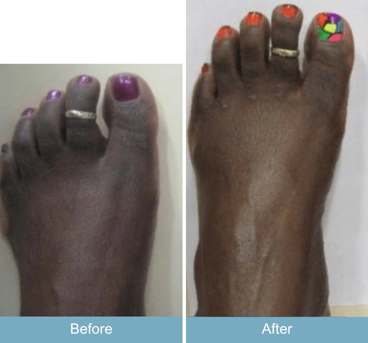 Before and after foot with bunion and swelling, showing reduced inflammation and improved alignment