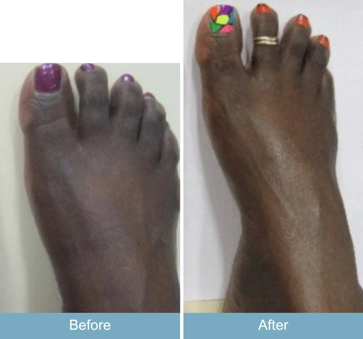 Before and after foot showing reduced swelling and improved appearance