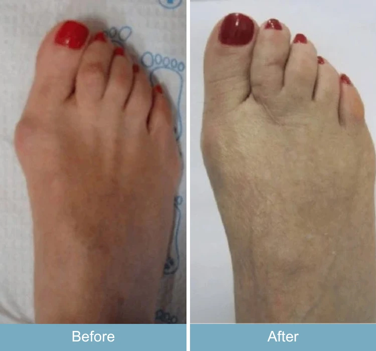 Before and after comparison of foot showing reduced bunion and swelling