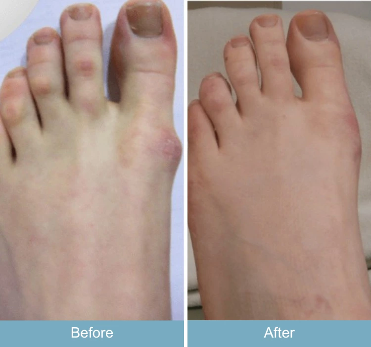 Before and after foot with bunion and nail deformity, showing improved alignment and nail appearance