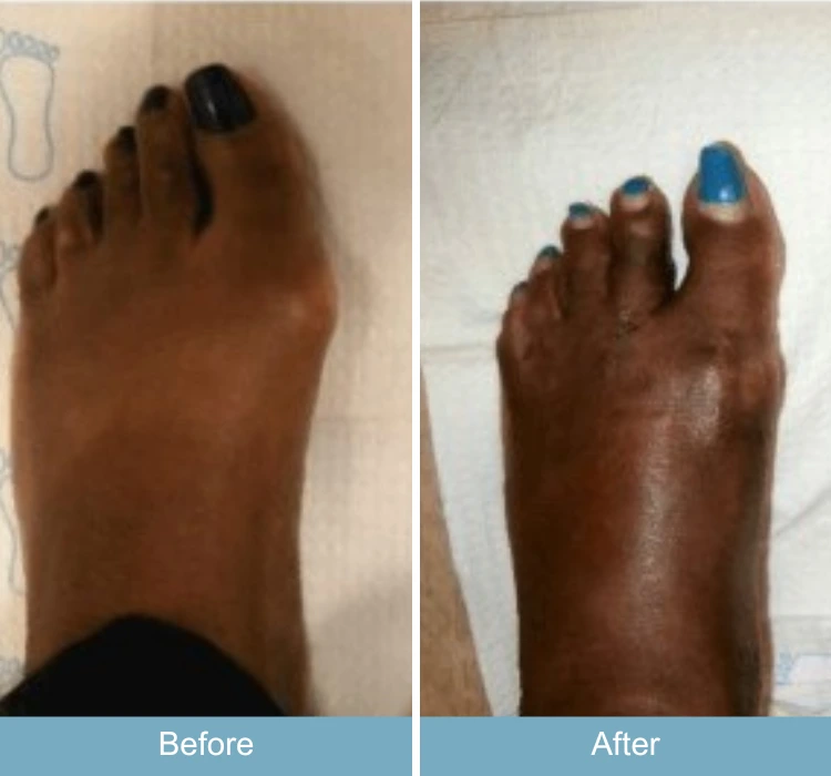 Before and after foot with bunion and swelling, showing decreased inflammation and improved alignment