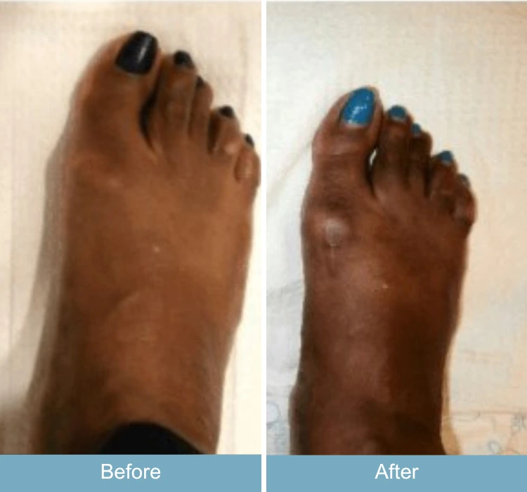 Before and after foot with bunion and swelling, showing reduced inflammation and improved shape