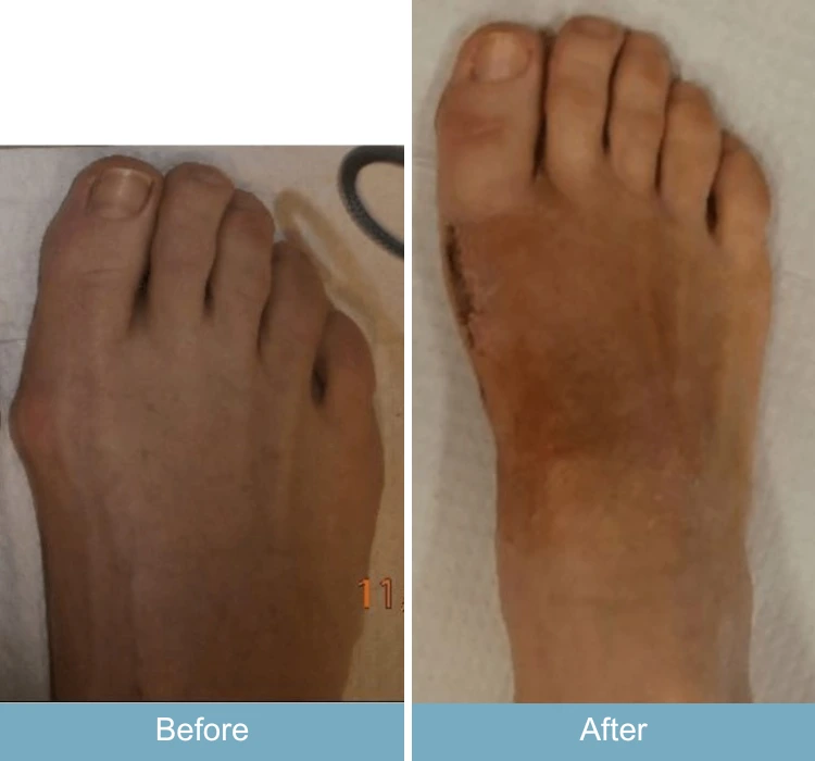 Before and after foot with bunion and swelling, showing reduced bunion prominence and improved contour
