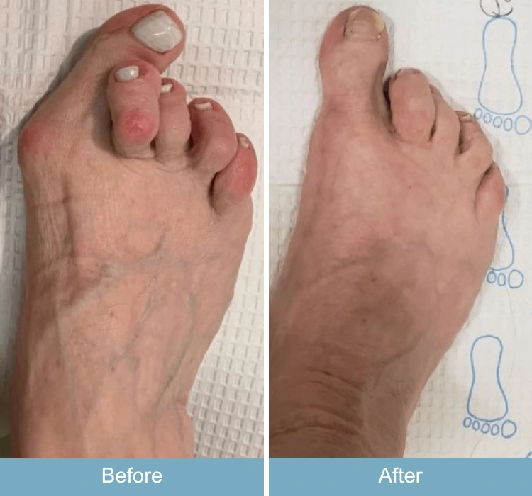 Before and after foot comparison showing bunion correction with toe alignment diagrams