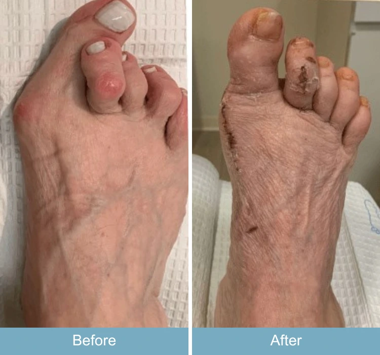 Before and after foot comparison showing bunion reduction and toe alignment improvement