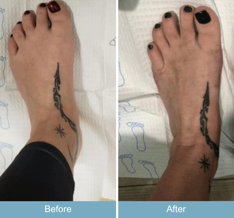 Before and after foot comparison showing bunion improvement with tattoo marking