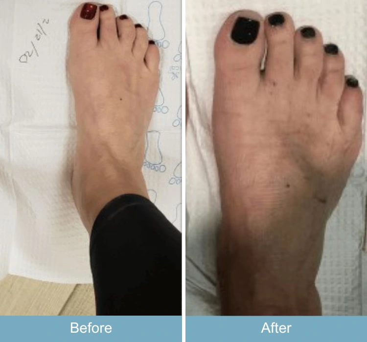 Before and after foot comparison showing bunion reduction and decreased swelling