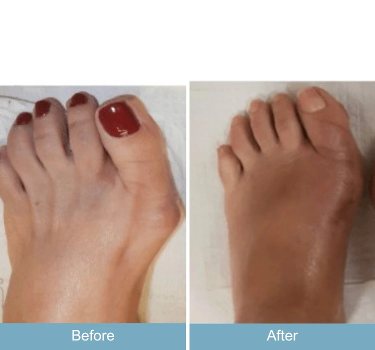Before and after foot comparison showing bunion correction and swelling reduction