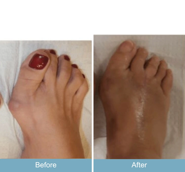 Before and after foot comparison showing bunion reduction and toe realignment
