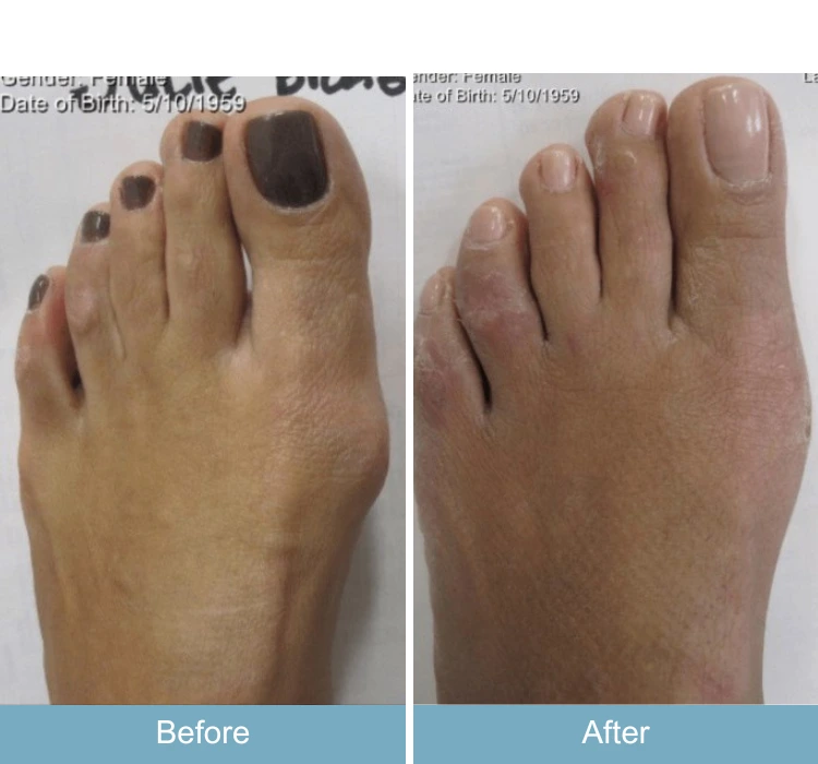 Before and after foot showing reduced bunion prominence and improved toe alignment