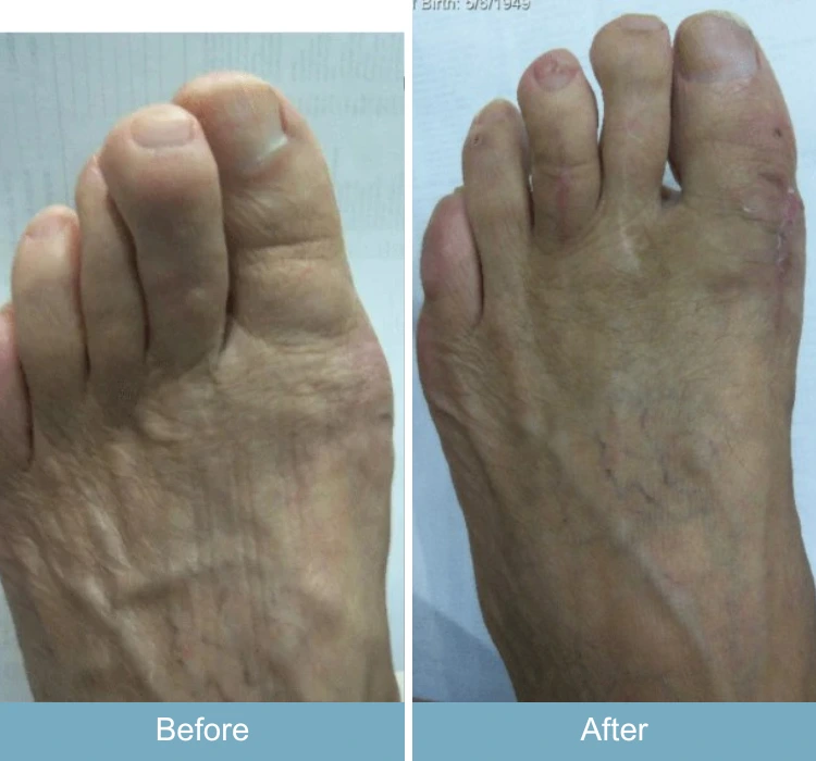 Before and after foot showing corrected bunion deformity with straighter big toe
