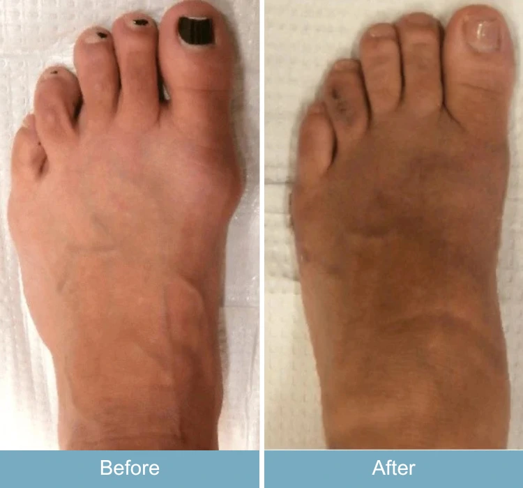 Before and after foot showing reduced swelling and improved alignment of toes