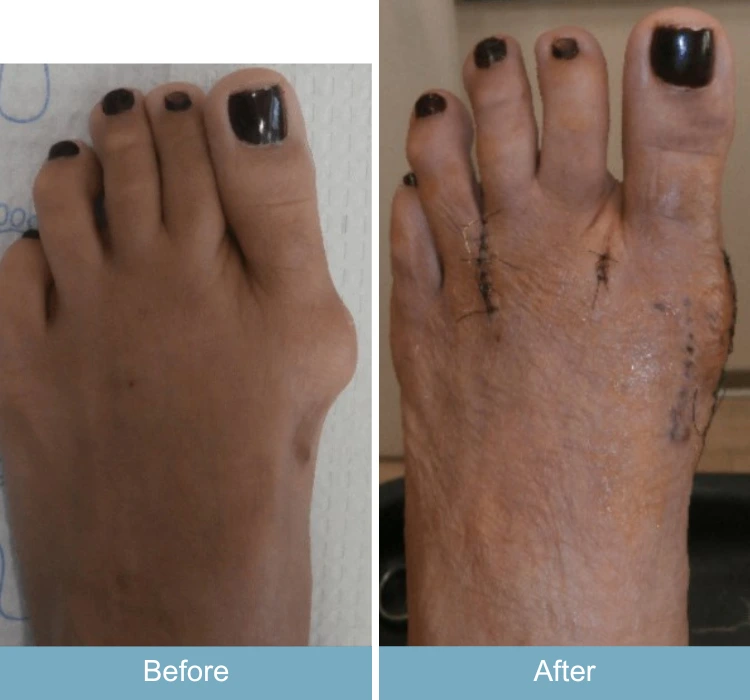 Before and after foot showing reduced bunion size and improved foot shape